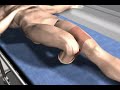 Cross Stump Procedure