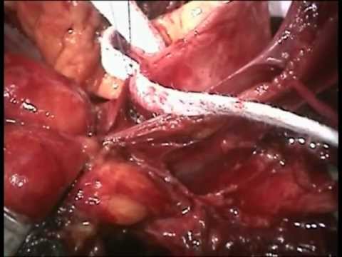 how to repair arteries