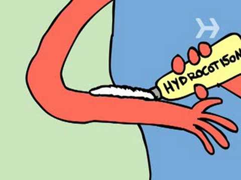 how to recover sunburn