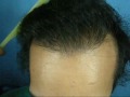 Vicky Hanjan - (1890 FUHT grafts) repair update for plug grafts