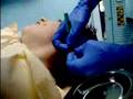 dermal punch