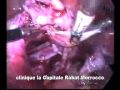 Coeliochirurgie du kyste ovarien endométriosique.mp4