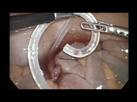 how to unclog pd catheter