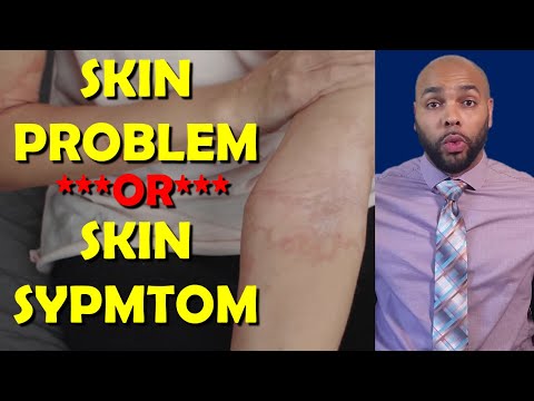 how to know if its eczema