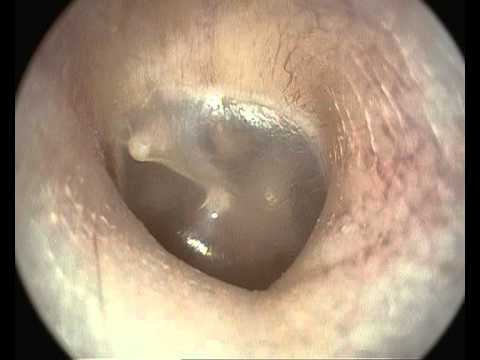 how to perform pneumatic otoscopy