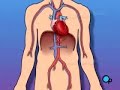 PreOp® Patient Education Heart Stent Implant Angioplasty