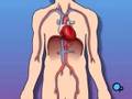 PreOp® Patient Education Heart Stent Implant Angioplasty