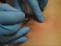 Sebaceous Cyst Removal from Back - Done in Home- Alabama Style