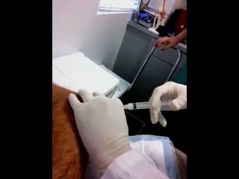 how to drain bursitis