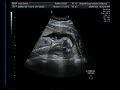 Benk? Zsebibaba 20 hetes 4D ultrahang - 4D ultrasound