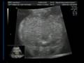 videos de Benkő Zsebibaba 20 hetes 4D ultrahang - 4D ultrasound