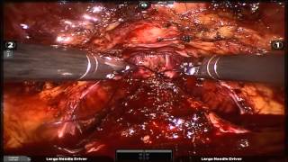 Robotic prostatectomy surgery in Singapore for prostate cancer