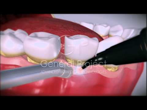Dental Laser System 4x4