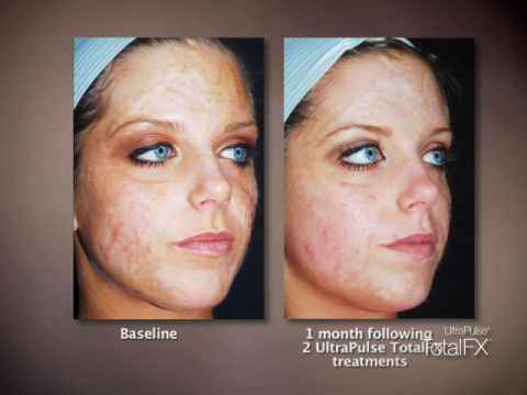 how to treat ipl laser burns