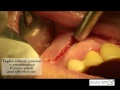 Apicectomy