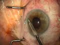 Ant. Vitrectomy & Secondary A/C IOL, Pt. 1 of 3
