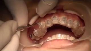 Use printed bonding tray for Orthodontic technology