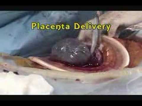 C-Section with the Mobius® elastic ...
