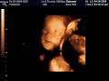 Twins at 28 weeks, 3D ultrasound in color, part 1