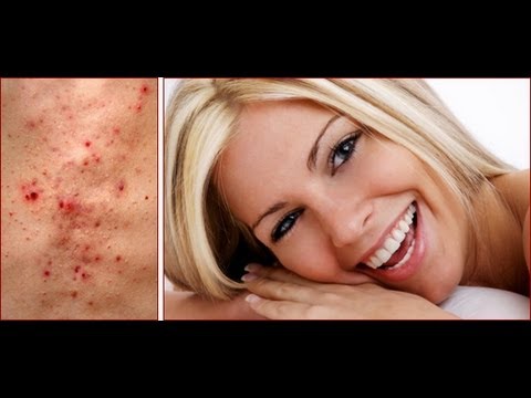 How to Treat Cystic Acne