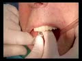 Flapless Tecnique en implantes dentales
