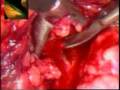 Kidney Stone