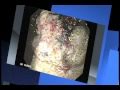 Gastrointestinal Endoscopy Presentation