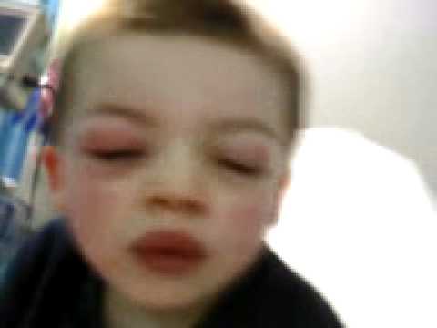 how to cure ibuprofen allergy