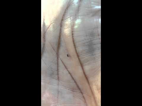 how to treat noseeum bites