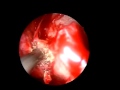 Infratemporal Fossa Tumor