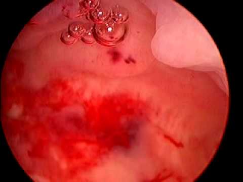 how to get rid of s'sinus infection