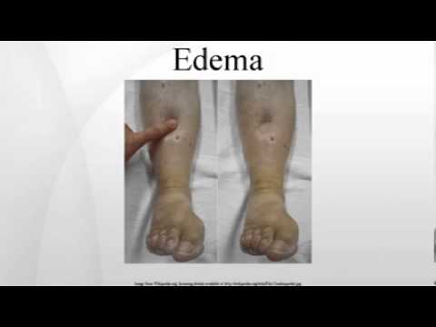 how to assess edema
