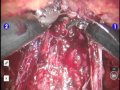 Prostate Resection Prostate Resection