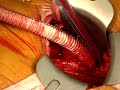 Leading cardiac and vascular surgeons from Brigham and Women's Hospital will webcast a live minimally invasive endovascular thoracic aortic stent-graft repair.A thoracic aortic aneurysm is a widening or bulging of part of the wall of the aorta within the chest -- the body's largest artery. The risk factors for thoracic aneurysms include atherosclerosis, hypertension, and a history of smoking. Treatment of thoracic aortic aneurysm traditionally involves surgery to replace the damaged portion of the aorta with polyester graft. Recently developed as an alternative to the conventional open surgical repair, which requires a major operation with the possibility of complications, and a long recovery,...