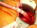 Podcast: Brigham and Women's Hospital Cardiac and...