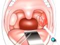 videos de Malpractice Medical Tonsillectomy Surgery 3