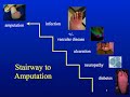 Stairway to Amputation Stairway to Amputation