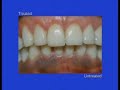 Gum Bleaching - Los Angeles Periodontist / Dentist Dr. Farno Gum Bleaching - Los Angeles Periodontist / Dentist Dr. Farno