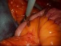 Dr Rutledge Narrates Removal Failed LapBand + MGB