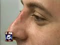 Non Surgical Nose Job By Dr. Cameron Rokhsar
