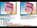 Simple Exercises to Stop Snoring Reduce Sleep Apnea