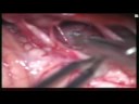 Doctors Remove Worm From Woman\