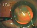 Capsulorrhexis by Direct Needle Puncture Dr. Sudhalkar