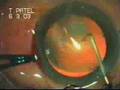 Capsulorrhexis by Direct Needle Puncture Dr. Sudhalkar