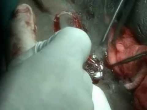 vulva