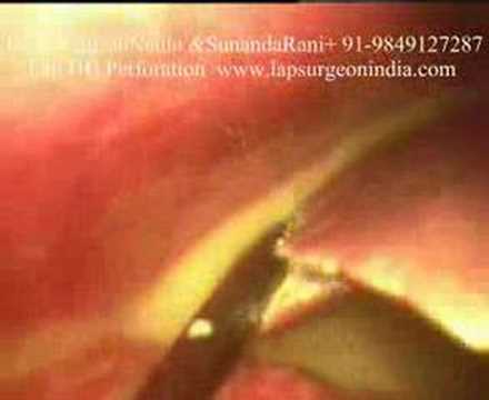 Laparoscopy DU Perforation Closure ...