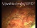 Laparoscopy DU Perforation Closure Video (Lap Peritonitis) Laparoscopy DU Perforation Closure Video (Lap Peritonitis)