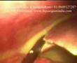 Laparoscopy DU Perforation Closure Video (Lap Peritonitis)