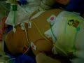 Alana-Maé en réa (4/8) Pneumothorax Alana-Maé en réa (4/8) Pneumothorax