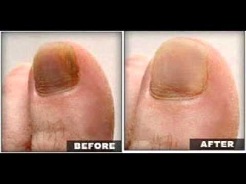 how to get rid yellow toenails